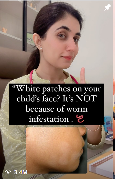 White patches on your child's face — not worm infestation